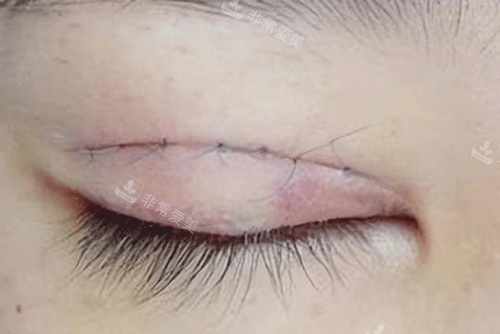 双眼皮疤痕明显照片 双眼皮疤痕明显照片