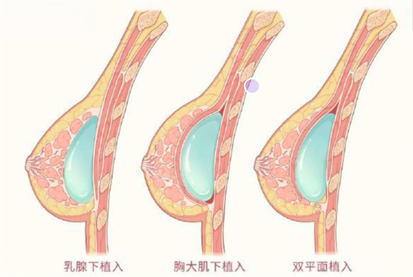 隆胸假体植入层次