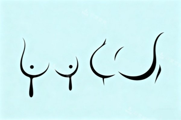 假体隆胸卡通图一览