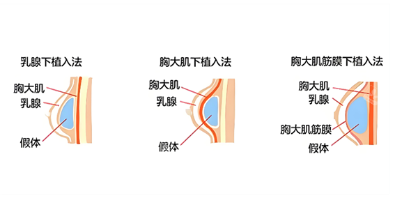 假体隆胸假体植入层次图