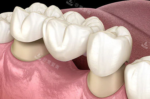 全瓷牙冠镶牙示意图