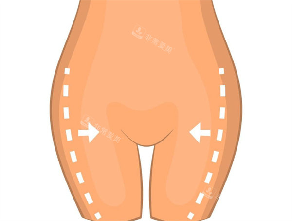 大腿吸脂手术卡通图