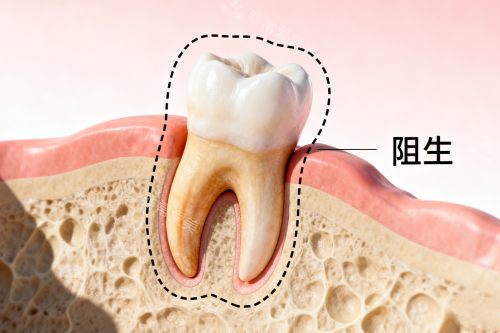 口腔智齿卡通展示图