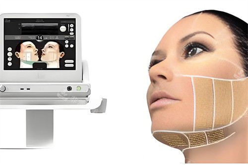 ulthera 超声提拉 ulthera 超声提拉