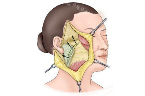 杜太超医生国内排名前三吗？33年专注拉皮！杜太超CAW提升术有多牛？国内排名与真实实力全揭秘