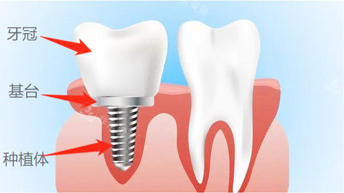 种植牙卡通图示