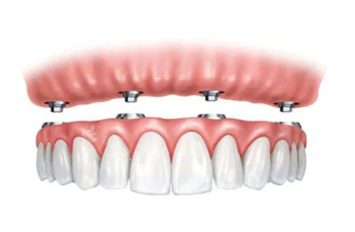 全口种植牙图示