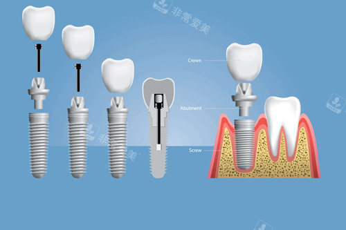 种植牙安装示意图