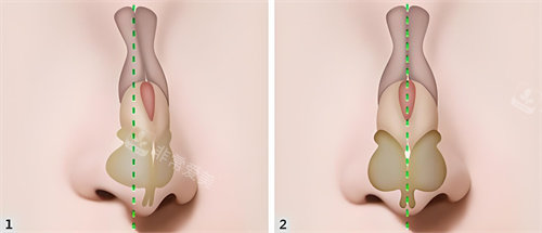 鼻梁矫正前后对比动画图 鼻梁矫正前后对比动画图