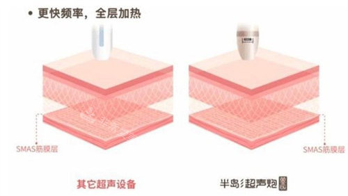 半岛超声炮和普通超声 半岛超声炮和普通超声