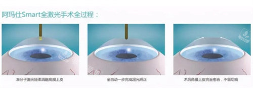 阿玛仕全激光手术全过程