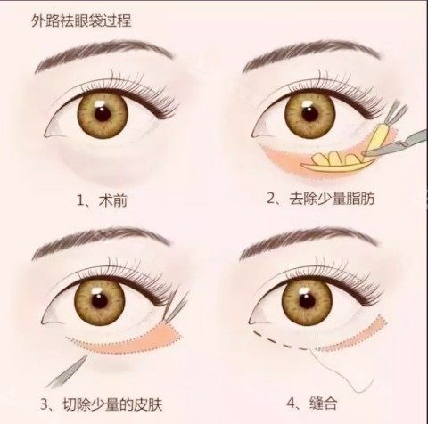 外路祛眼袋图示