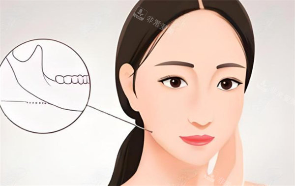 下颌角整形手术卡通图