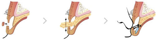 韩国bio整形眼部手术细节展示图 韩国bio整形眼部手术细节展示图