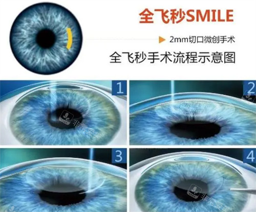 全飞手术流程示意图