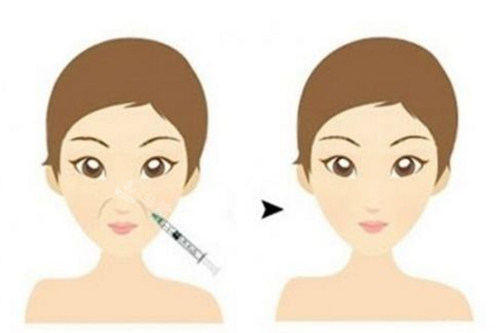 注射填充面部法令纹前后对比卡通示意图 注射填充面部法令纹前后对比卡通示意图
