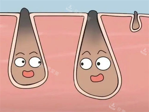 黑頭毛囊 黑頭毛囊