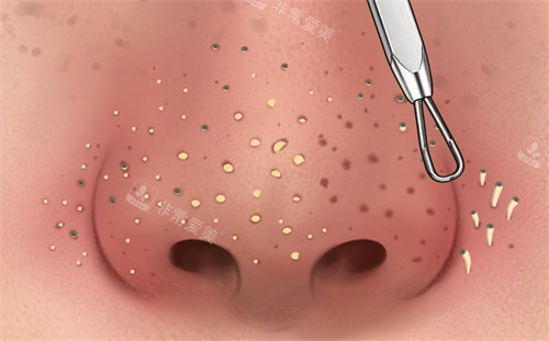 皮膚黑頭 皮膚黑頭