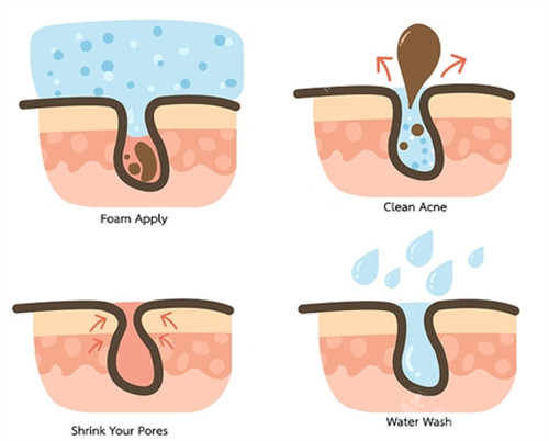不同的毛孔問(wèn)題 不同的毛孔問(wèn)題