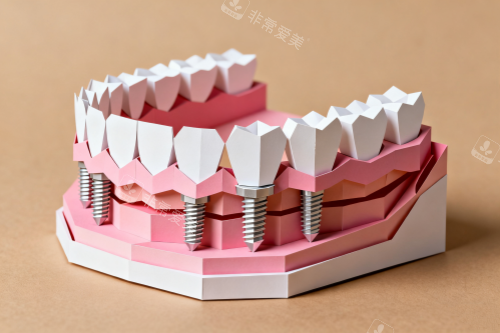 种植体卡通模型一览