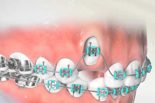 虎牙牙齿矫正过程