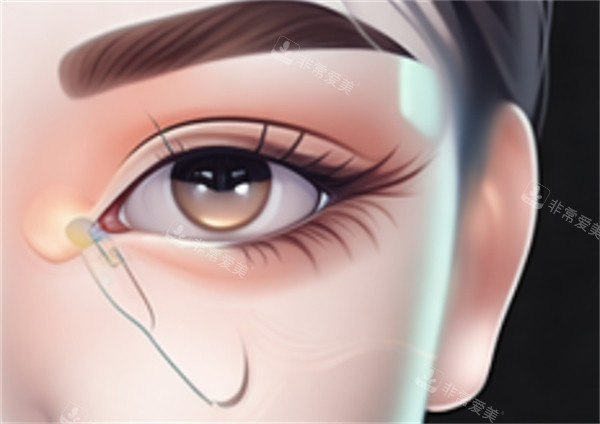 开眼角手术