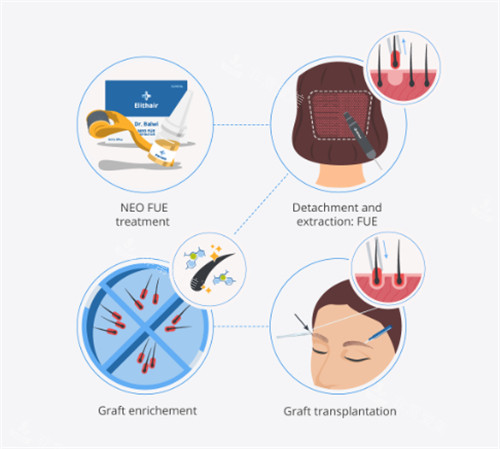 微针植发的过程图解 微针植发的过程图解