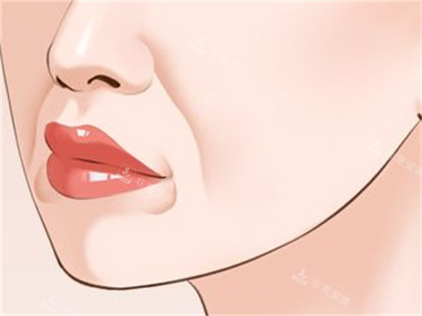 法令纹整形手术卡通图