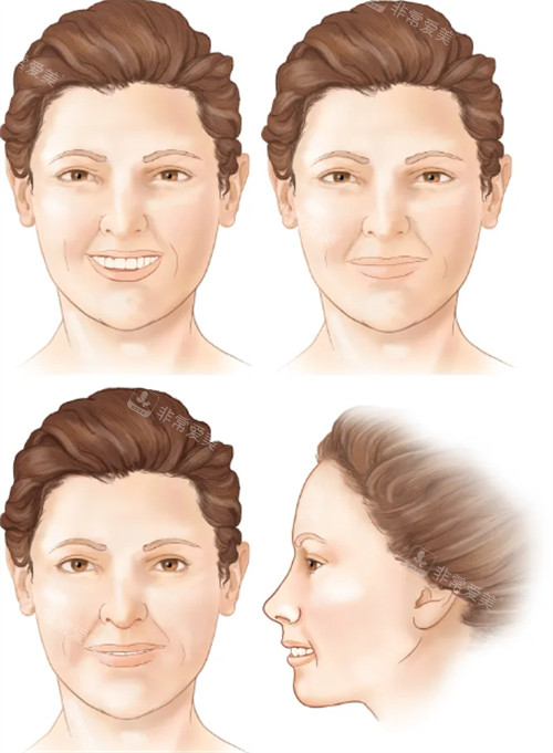 法令纹对面部整体影响