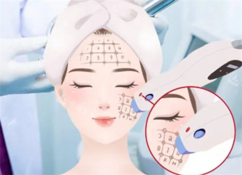 热玛吉操作卡通图