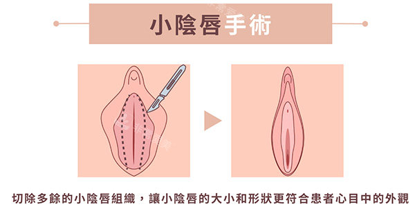 小阴唇整形手术前后照片