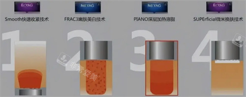 fotona4d欧洲之星四种模式