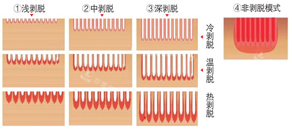 欧洲之星fotona4d各类模式照片