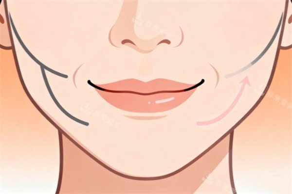 嘴角皱纹做提升卡通展示图