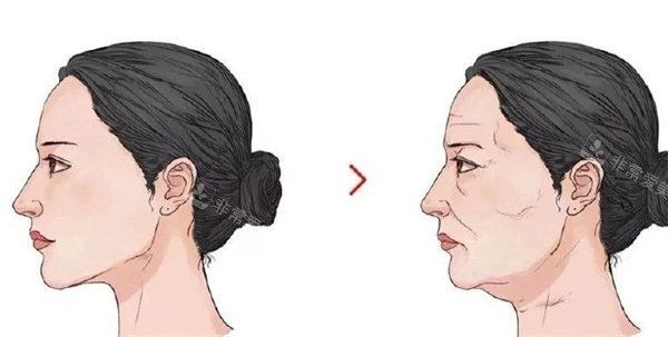 拉皮整形手术前后对比