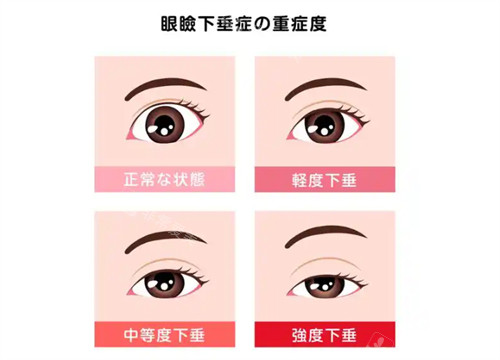 上睑下垂不同程度的样子