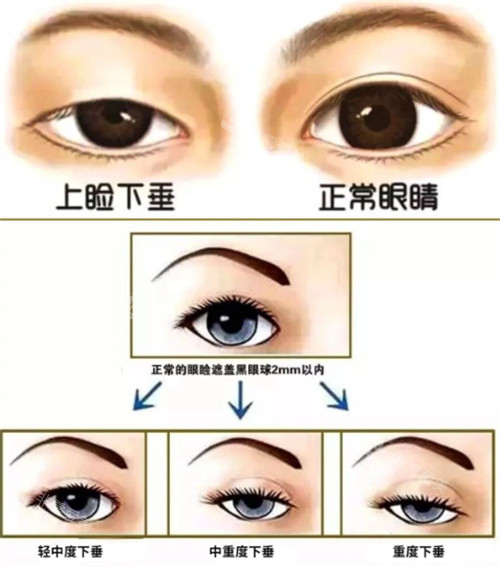 上睑下垂的不同程度