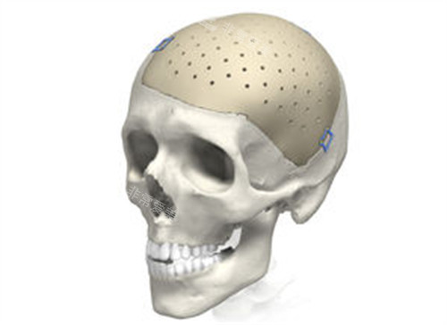 peek修补颅骨 peek修补颅骨