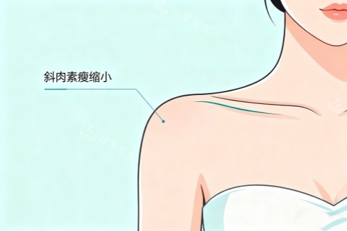 直角肩注射卡通图 直角肩注射卡通图