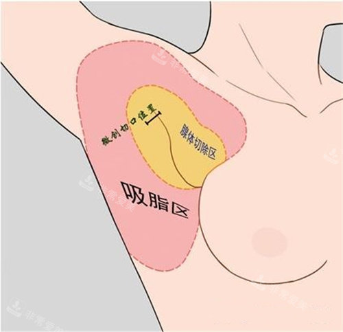 副乳切口位置与吸脂区动画演示图 副乳切口位置与吸脂区动画演示图