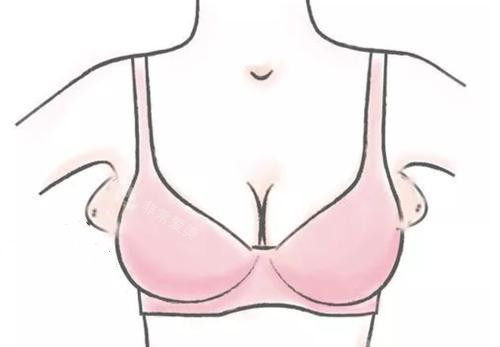 副乳位置卡通示意图 副乳位置卡通示意图