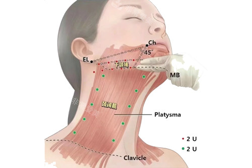 下颌缘和颈阔肌示意图
