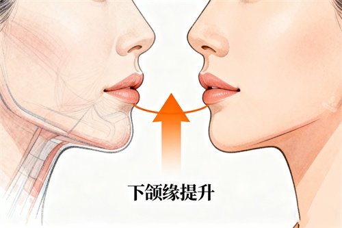 韩国下颌缘提升哪家医...