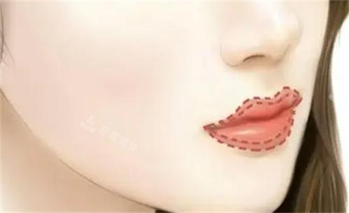 丰唇唇部画线填充图