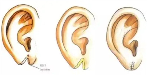 耳垂裂開修復(fù)的過程