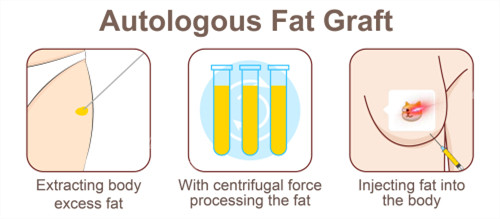 自体脂肪隆胸手术过程 自体脂肪隆胸手术过程