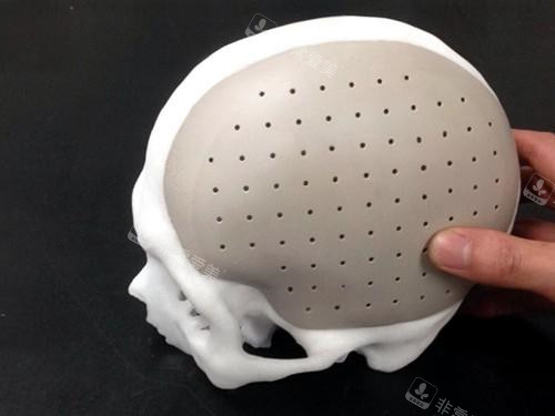 头部填充术peek展示图