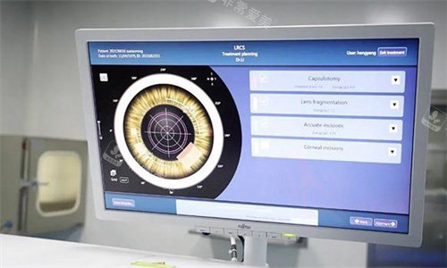 飞秒激光白内障