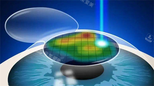 个性化微飞秒手术过程图片