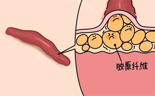 疤痕的形成原因